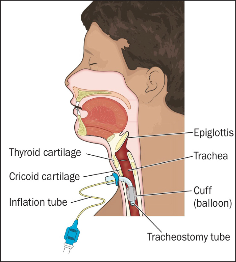 tracheostomy procedure anatomy