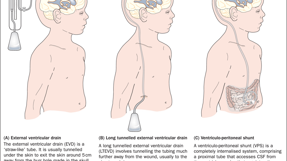 Pediatric Ventriculoperitoneal Shunt Malfunction / Malposition