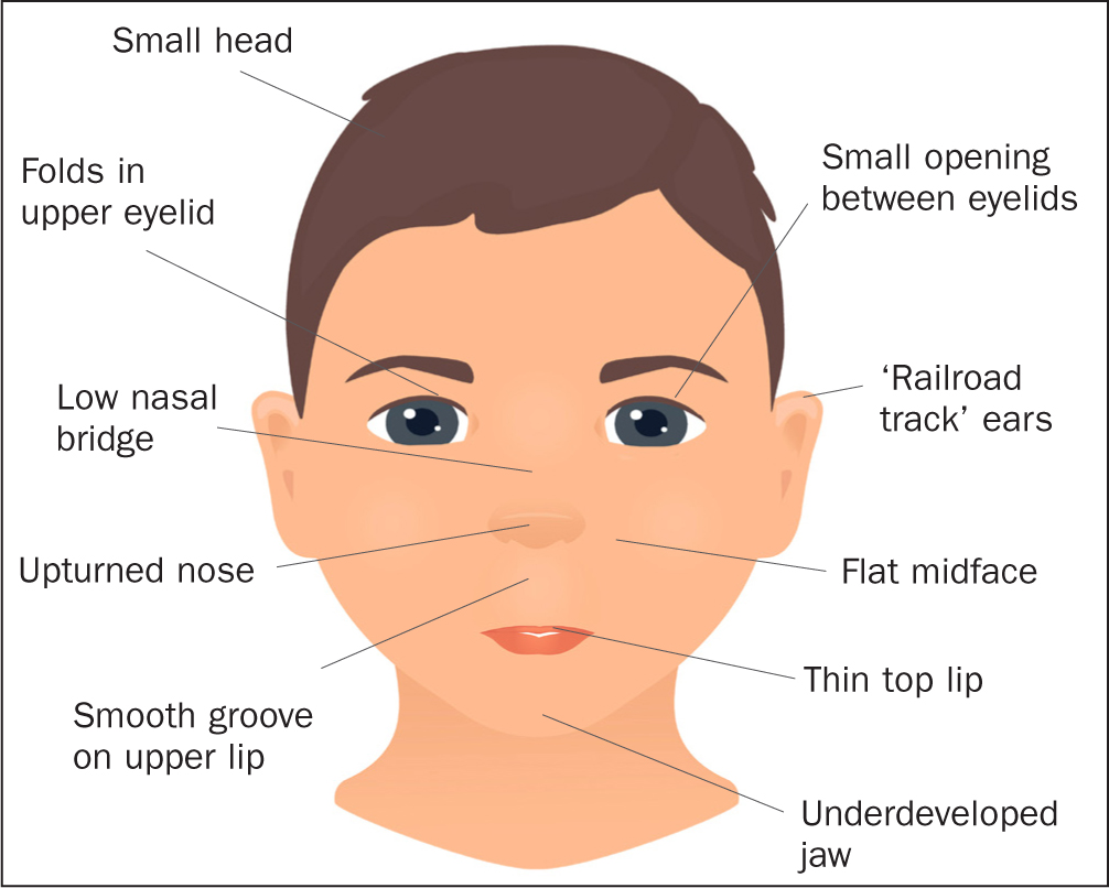 Fetal Alcohol Syndrome Facial Features