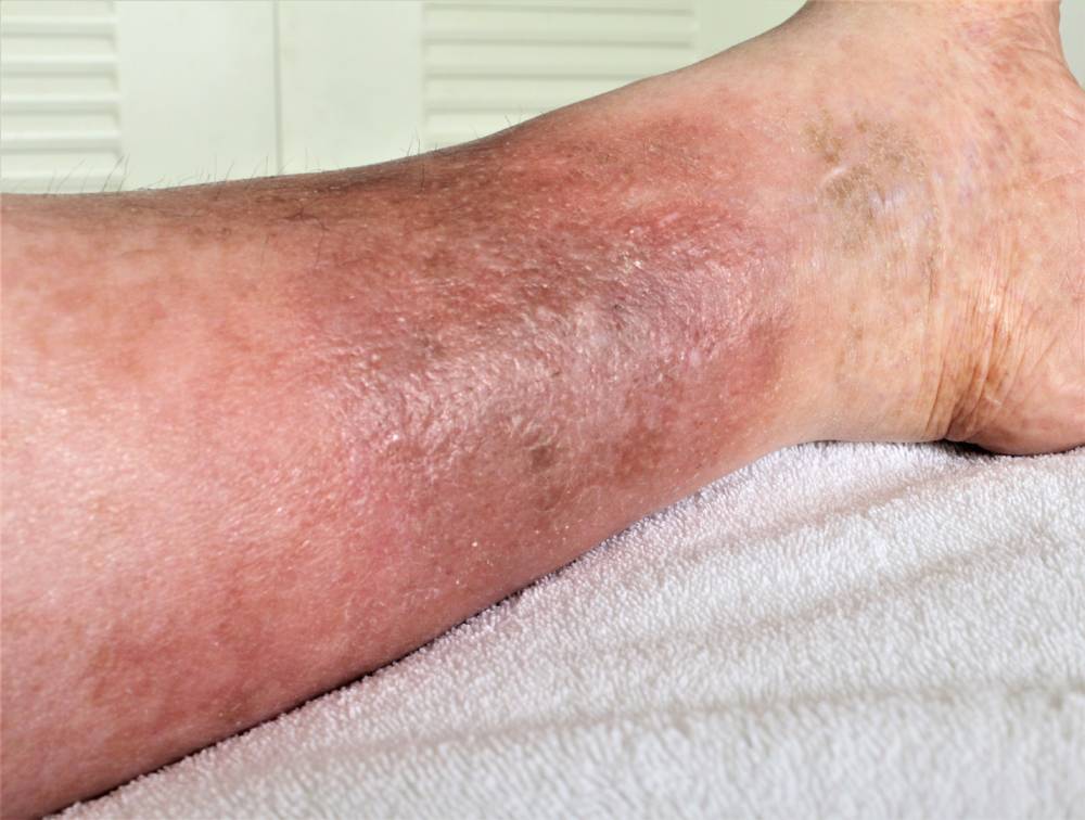 Chronic Cellulitis Lower Extremity